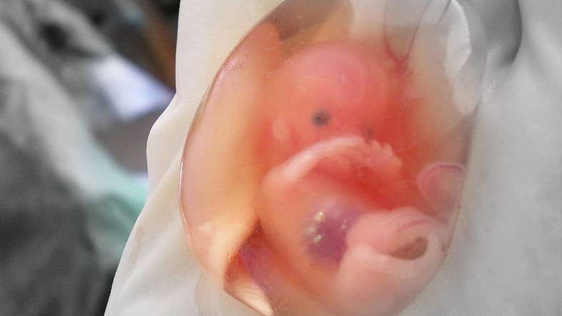 Tribunal Supremo de Alabama en los Estados Unidos dictamino que los embriones humanos congelados constituyen ninos segun la ley estatal